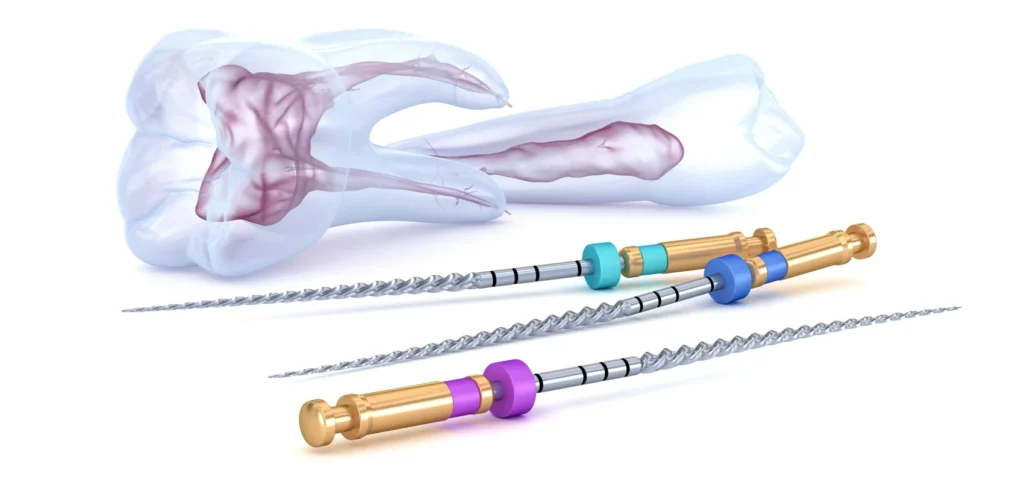 Dévitalisation - traitement endodontique - dentiste à Septeuil