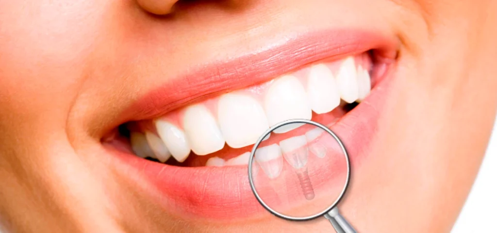 Implants dentaires - Dentiste à Septeuil