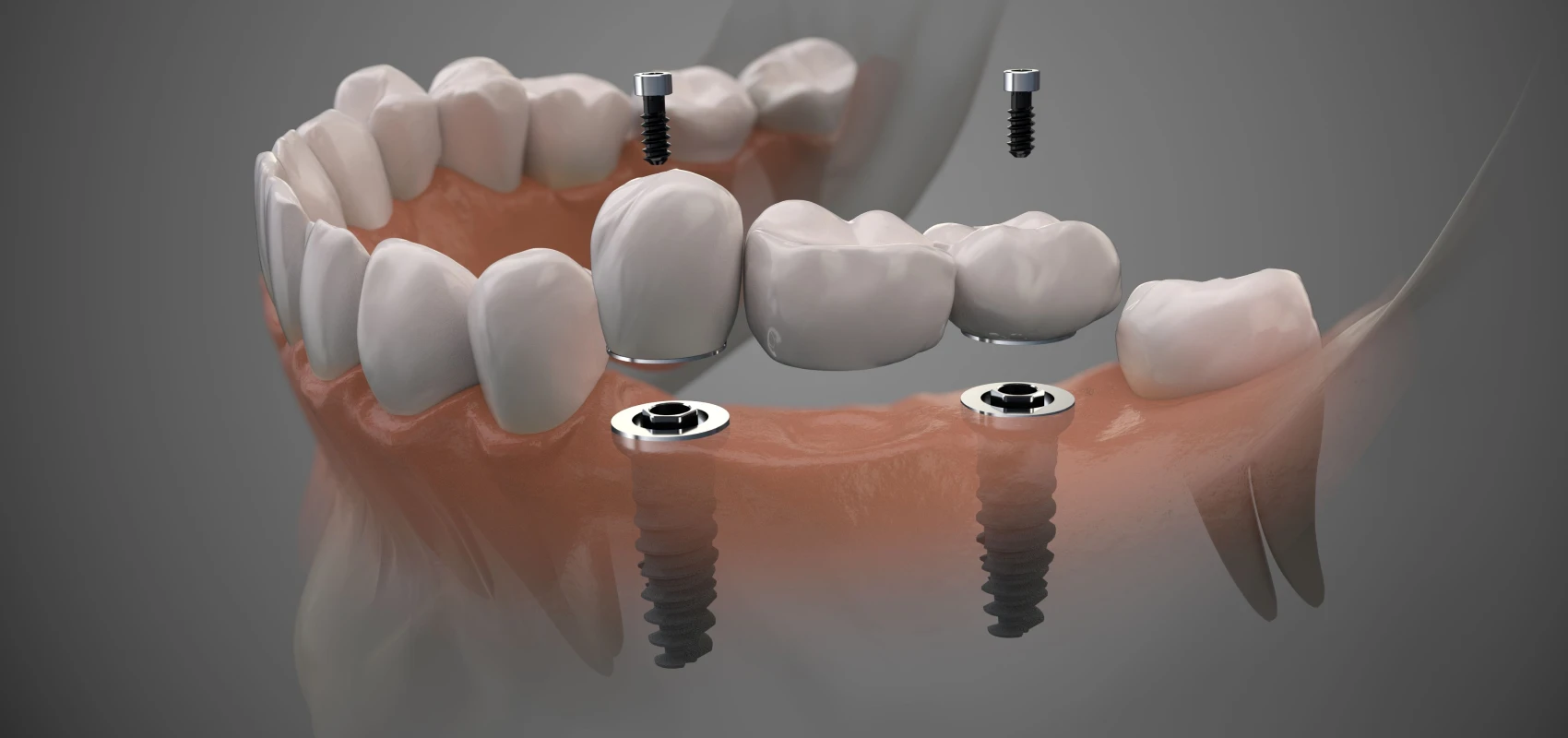 Prothèses sur implants - Dentiste Septeuil 78790
