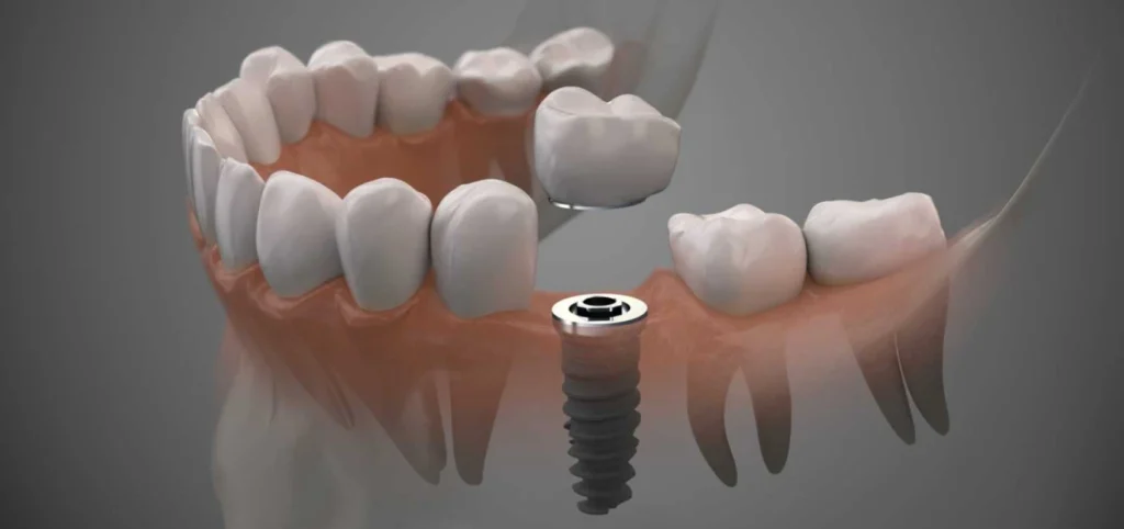 Implants dentaires - Dentiste Septeuil 78790