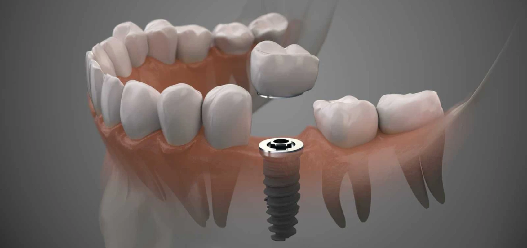 Implants dentaires - Dentiste Septeuil 78790
