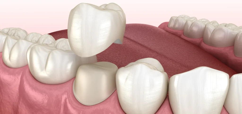 Couronne dentaire - dentiste Septeuil 78790